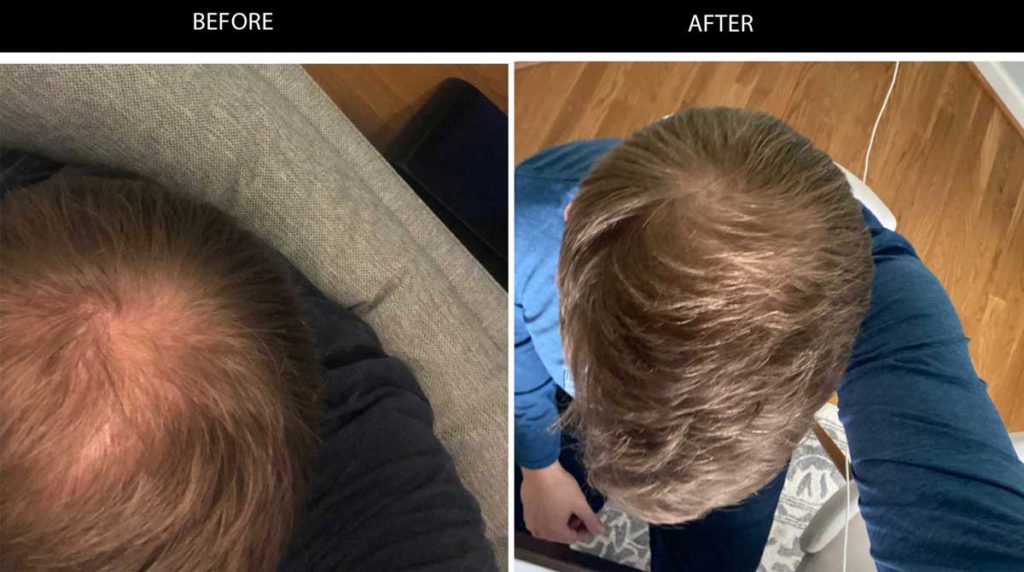 Keeps Review Does Keep Hair Loss Treatments